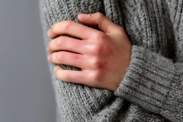 Uczulenie na zimno - czy to alergia? Rozpoznaj i lecz