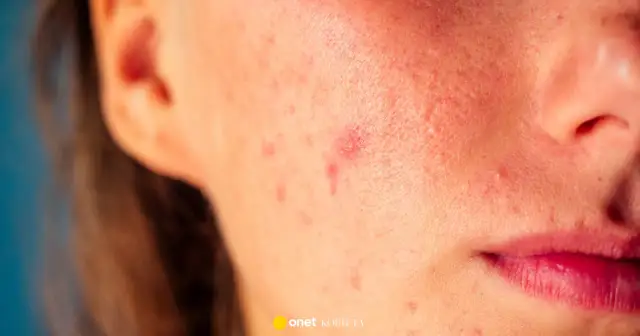 Pryszcz pękł? Goj ranę szybko i bez śladów porady eksperta