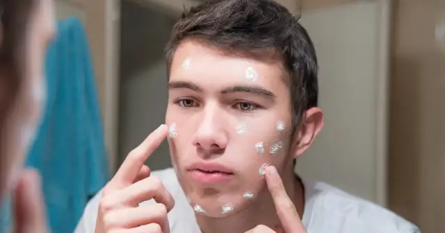 Dlaczego masz pryszcze? Odkryj prawdziwe przyczyny i leczenie