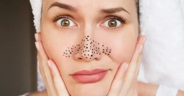 Pryszcze z apteki: Co wybrać? Skuteczne leki i porady ekspertki