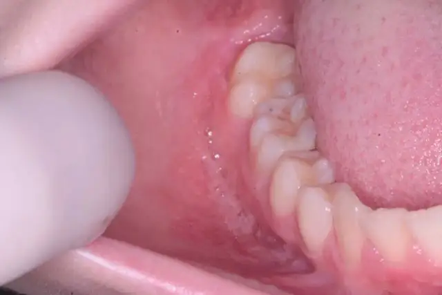 Choroba Leśniowskiego-Crohna: objawy w jamie ustnej, które musisz znać