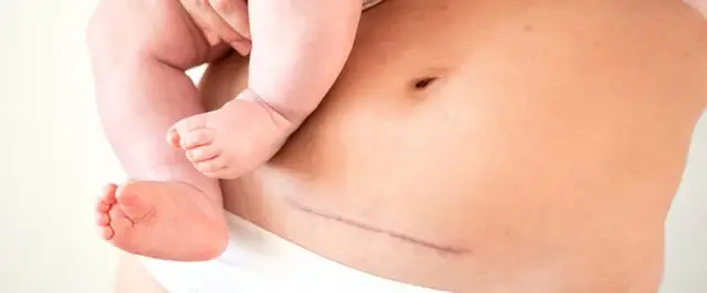 Kiedy zacząć ćwiczyć po cc, aby uniknąć powikłań i bólu?