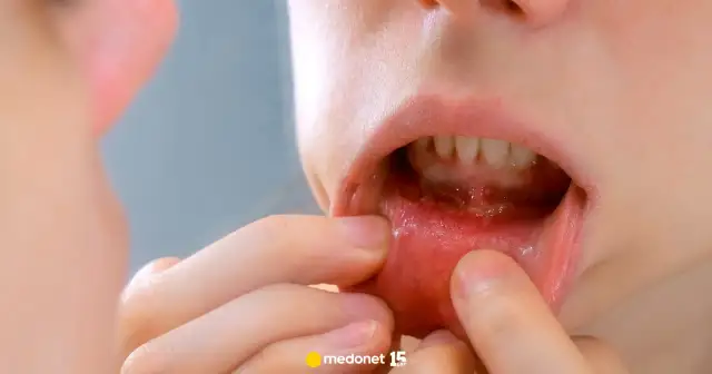 Opryszczkowe zapalenie jamy ustnej u dziecka: Ile trwa i jak ulżyć?