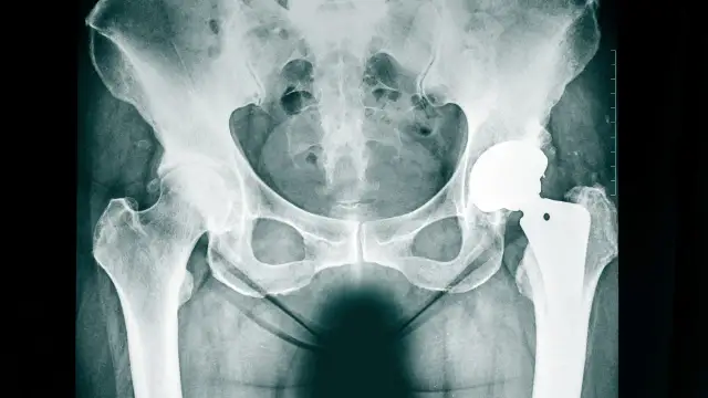 Jak długo odczuwa się ból po endoprotezie biodra? Oczekiwania i fakty