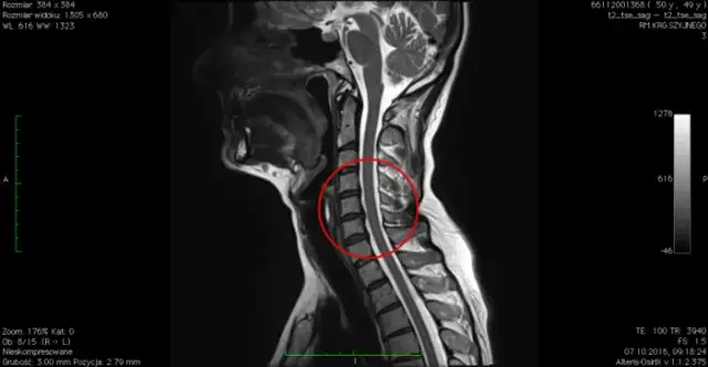Przepuklina kręgosłupa szyjnego C6-C7: objawy, diagnoza i leczenie