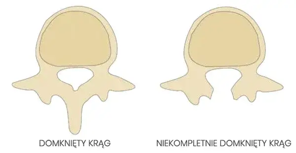 Bieganie z rozszczepem kręgosłupa: Kiedy tak, a kiedy unikać?