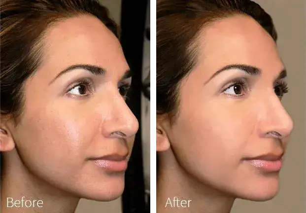 Laser frakcyjny co ile: jak uniknąć błędów w częstotliwości zabiegów