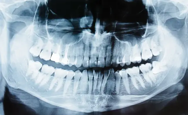 Ile kanałów ma ząb 1? Odkryj zaskakujące fakty o siekaczach