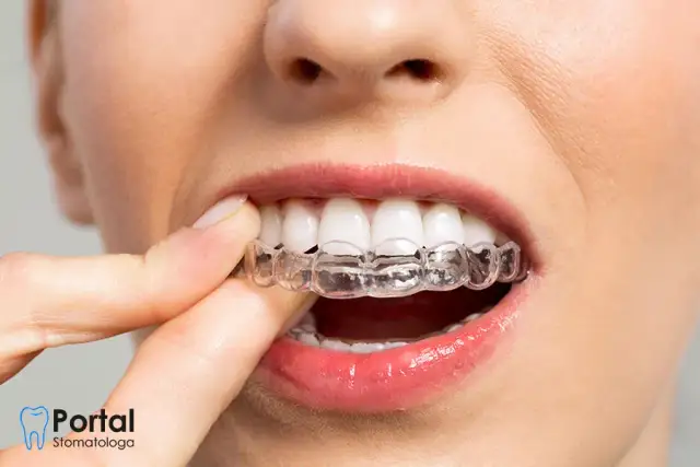 Aparat na noc: Ile kosztuje szyna relaksacyjna i retencyjna?