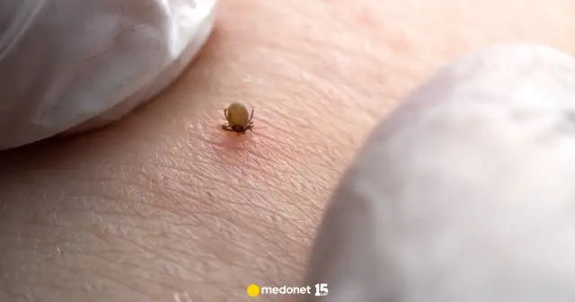 Kleszcz bez pęsety? Usuń go bezpiecznie! Unikaj tych błędów