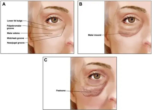 Opuchlizna na kościach policzkowych: przyczyny, które mogą zaskoczyć