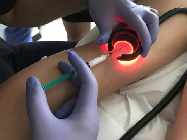 Czy alkohol po skleroterapii jest bezpieczny? Ekspert radzi