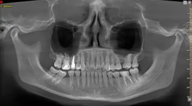 Czy pantomogram jest na NFZ? Sprawdź, co musisz wiedzieć, aby skorzystać
