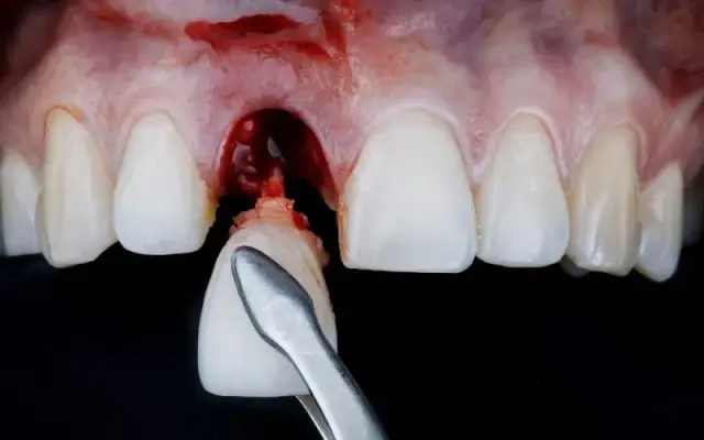 Krwawienie po wyrwaniu zęba: co jest normą, a kiedy do dentysty?