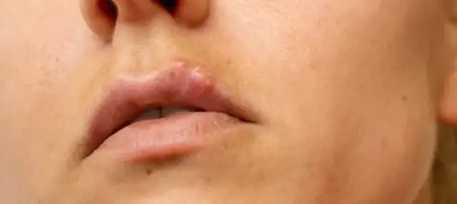 Opryszczka czy pryszcz: Kluczowe różnice i skuteczne leczenie