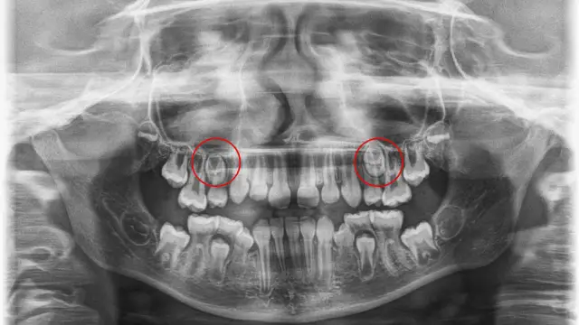 Czy pantomogram jest na NFZ? Sprawdź, co musisz wiedzieć o refundacji