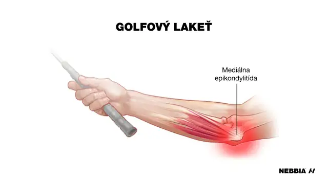 Ból łokcia przy zginaniu? Czy to łokieć tenisisty? Leczenie, ćwiczenia