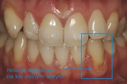 Recesja dziąseł objawy: Jak rozpoznać niepokojące symptomy?