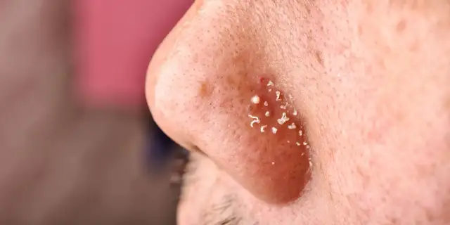 Co na pryszcze na twarzy? Skuteczne leczenie i pielęgnacja