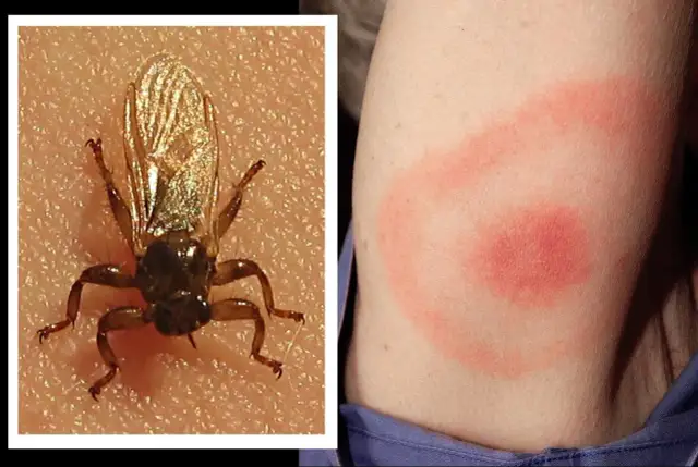 Latający kleszcz: objawy ukąszenia, czy grozi boreliozą?