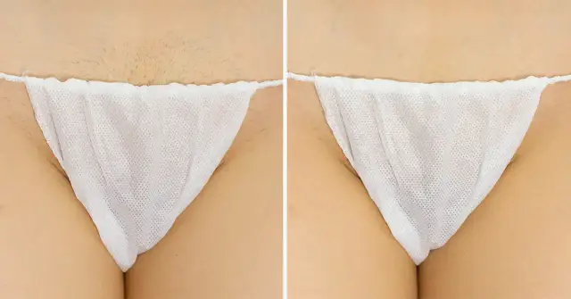 Ile zabiegów laserem na bikini potrzebujesz dla trwałych efektów?