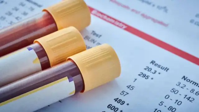 Czy przed badaniem krwi można myć zęby? Co musisz wiedzieć, aby nie zaszkodzić wynikom