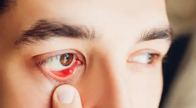 Skuteczne leki na jęczmień, które szybko przyniosą ulgę