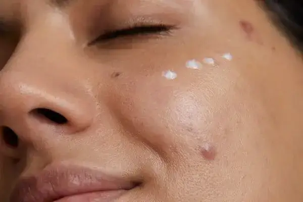 Jakiej witaminy brakuje, gdy wyskakują pryszcze? Sprawdź przyczyny!