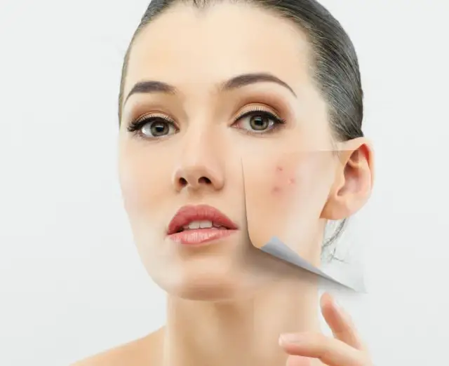 Zaczerwienienie po pryszczu? Natychmiastowe triki i trwała ulga