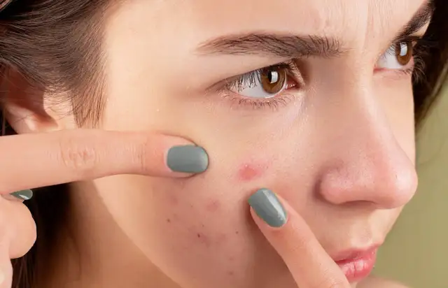 Czy powinno się wyciskać pryszcze? Poznaj ryzyko i skutki tej praktyki