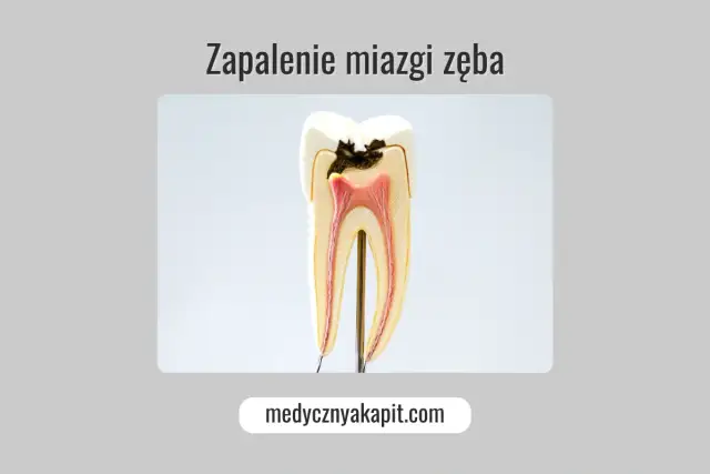 Zakażenie od zęba: Objawy ogólnoustrojowe i groźne powikłania