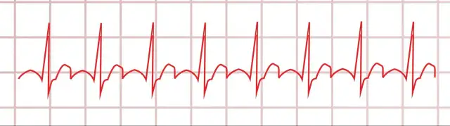 Myokarditis Diagnostik EKG: EKG-Befunde verstehen und richtig deuten