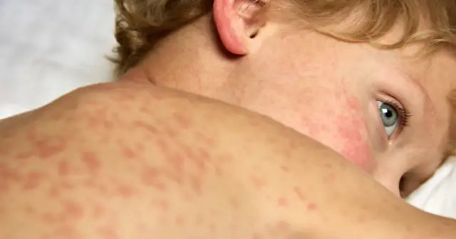 Różyczka czy uczulenie - jak odróżnić wysypkę u dziecka?