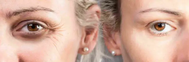 Co to jest botoks? Poznaj skutki i zastosowanie w medycynie estetycznej