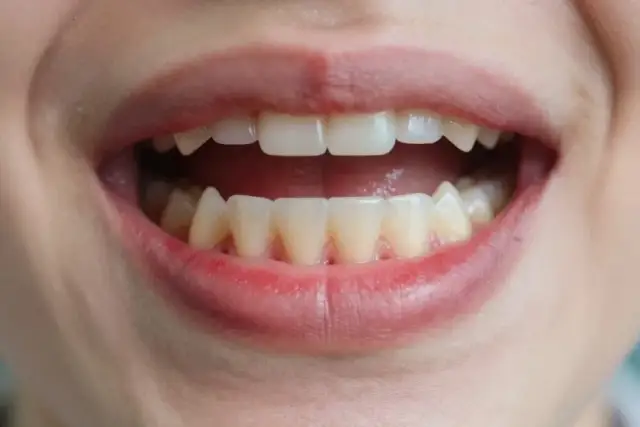 Zapalenie dziąseł: Rozpoznaj i wylecz, zanim będzie za późno
