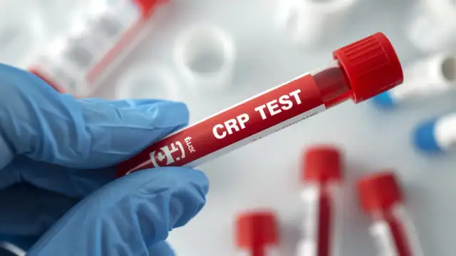 CRP: Co to jest, jak interpretować i kiedy do lekarza?