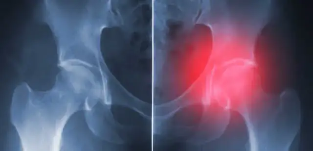 Jakie endoprotezy stawu biodrowego refunduje NFZ i co musisz wiedzieć