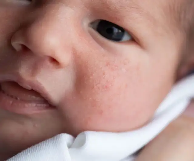 Alergia u niemowlaka: jak rozpoznać objawy i pomóc dziecku?