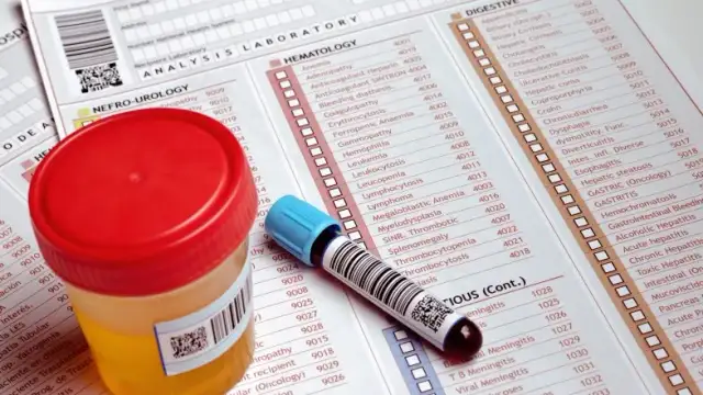 Ile moczu do badania ogólnego? Sprawdź, jak pobrać próbkę