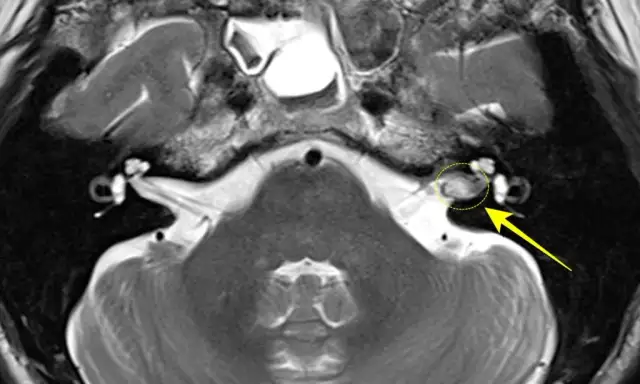 Nerwiak nerwu słuchowego: objawy, diagnoza i co musisz wiedzieć