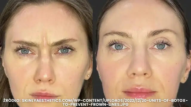 Lwia zmarszczka: botoks kiedy efekty i jak długo się utrzymają?