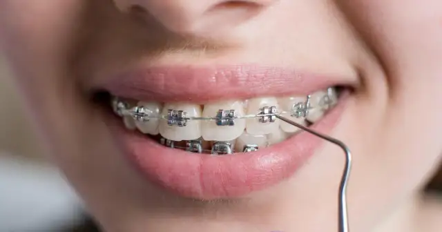 Czy potrzebujesz aparatu na zęby? Sprawdź objawy i wady zgryzu.