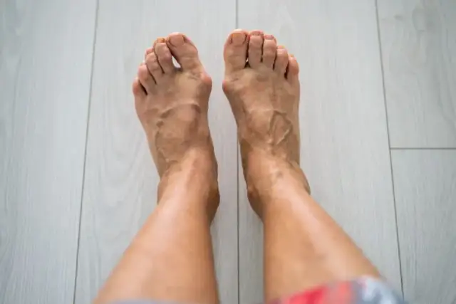 Haluksy: Skuteczne leczenie i ulga w bólu co naprawdę działa?