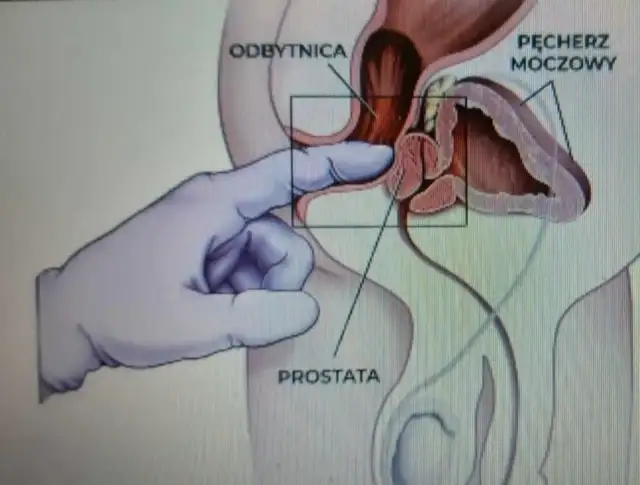 Rękawiczka wchodzi do odbytnicy, dotykając prostaty. To ilustracja badania, nie masaż grecki.