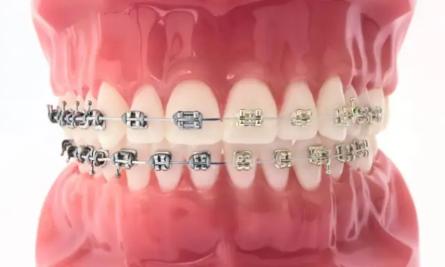 Zakładanie aparatu na zęby: Ile trwa? 45 min - 2h i co dalej?
