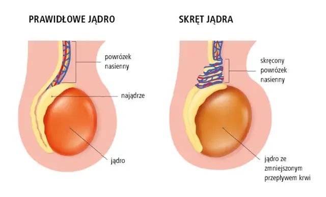 Ból jądra: Jaki lekarz? Kiedy liczy się każda minuta?
