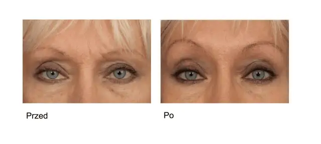 Kwas hialuronowy czy botoks pod oczy – który zabieg naprawdę działa?