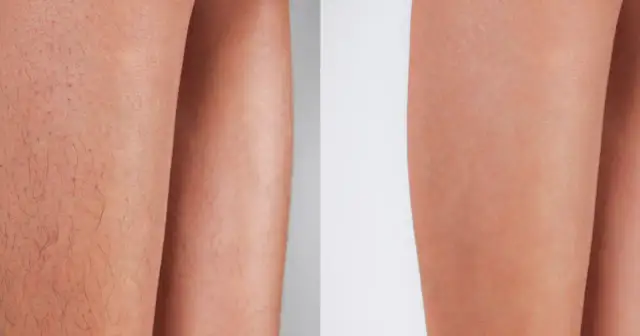 Ile trwa depilacja laserowa bikini? Od wizyty po trwały efekt