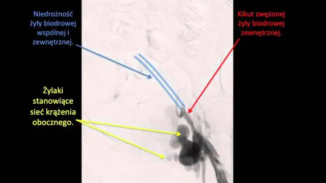 Niedrożność tętnicy biodrowej objawy: jak rozpoznać i leczyć?