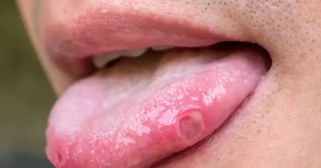 Widoczne są bolesne rany na języku, które utrudniają jedzenie i mówienie.